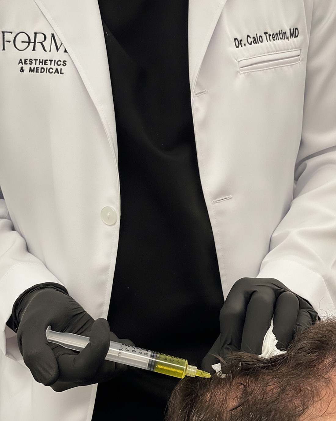 Dr. Trentin — PRP for hair